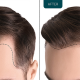 Hair transplant mumbai - Jata Hair Clinic