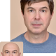 Advanced Hair Restoration