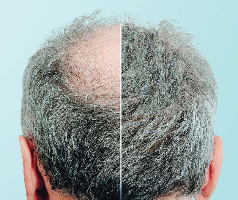 Jata hair science - Leading Hair Transplant Clinic in Mumbai