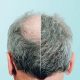 Jata hair science - Leading Hair Transplant Clinic in Mumbai