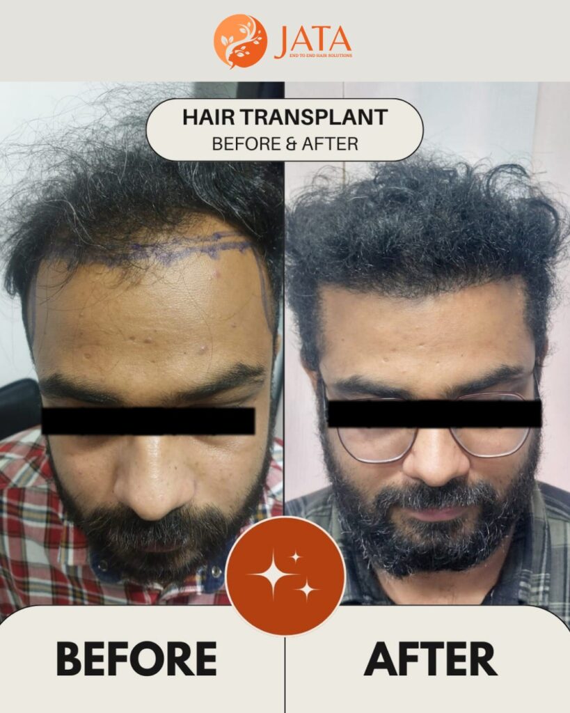 #HairTransplantIndia #BestHairTransplantMumbai #FUEHairTransplant