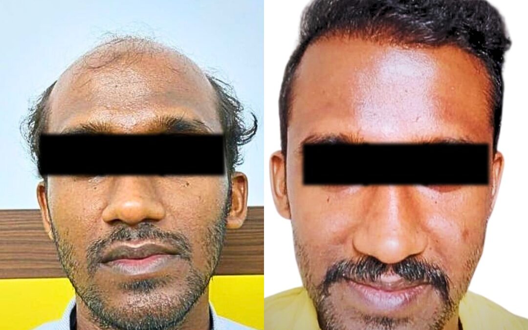 #BeardTransplantMumbai #HairRestorationClinic #HairLossTreatmentMumbai #BaldnessTreatment