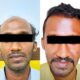 #BeardTransplantMumbai #HairRestorationClinic #HairLossTreatmentMumbai #BaldnessTreatment